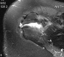 Os Acromionale MRI 2